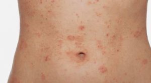 osip na koži, dermatitis