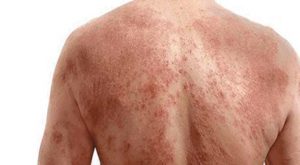 infekcije kože, grinje, bakterije