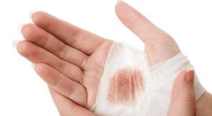 kožne rane i ozljede kože