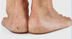 za suhu i ispucalu kožu